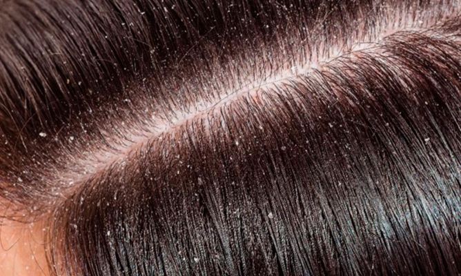 How to eliminate dandruff from the scalp permanently