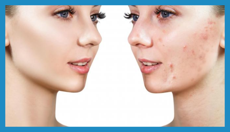 Por que se produce el acné y como eliminarlo definitivamente