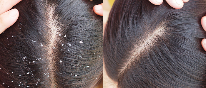 Natural Remedies to Eliminate Dandruff