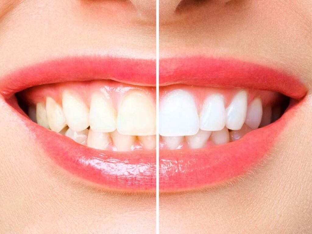3. Strawberries: whiten teeth 
