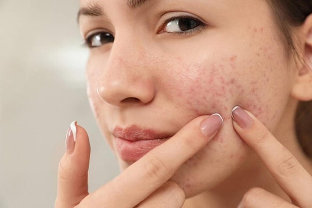Effective Home Remedies to Eliminate Acne: Clear and Healthy Skin
